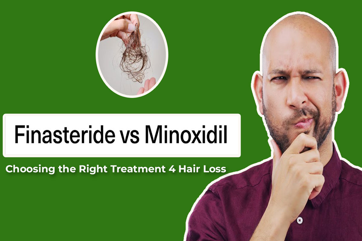 You are currently viewing Minoxidil vs. Finasteride Choosing the Right Treatment 4 Hair Loss