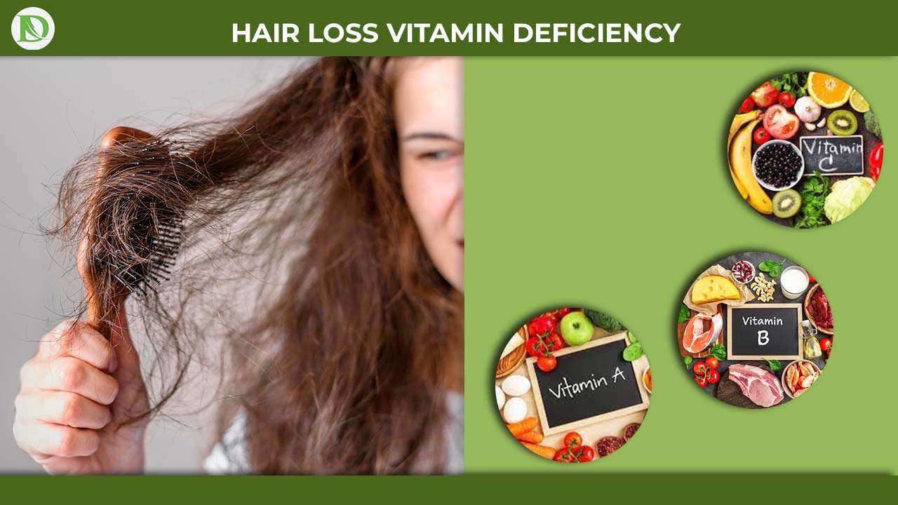 You are currently viewing Which vitamin deficiency causes hair loss?: Unraveling the secret